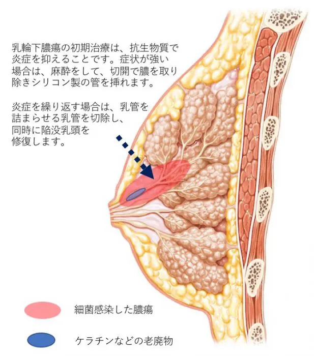 授乳期乳腺炎 乳輪下膿瘍 肉芽腫性乳腺炎 練馬駅前内視鏡 乳腺クリニック